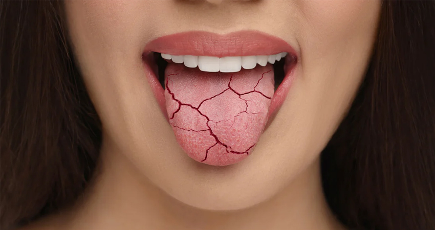 How to Relieve Dry Mouth Problems?